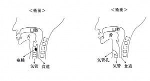 喉頭全摘出術と気管孔造設術