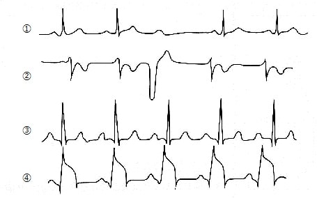 房室ブロック時の心電図