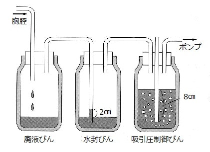 胸腔内持続吸引